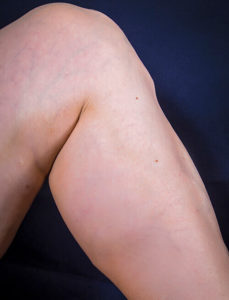 PCI Clinic - Edward Poon MD - Varicose Vein After