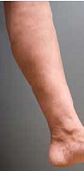 PCI Clinic - Edward Poon MD - Varicose Vein B After