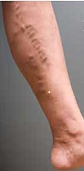 PCI Clinic - Edward Poon MD - Varicose Vein B Before