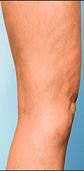 PCI Clinic - Edward Poon MD - Varicose Vein A After