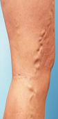 PCI Clinic - Edward Poon MD - Varicose Vein A Before