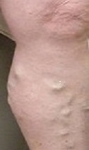 PCI Clinic - Edward Poon MD - Varicose Vein C Before